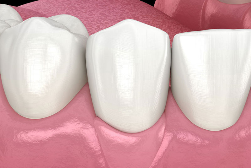 Osseous surgery 3d model