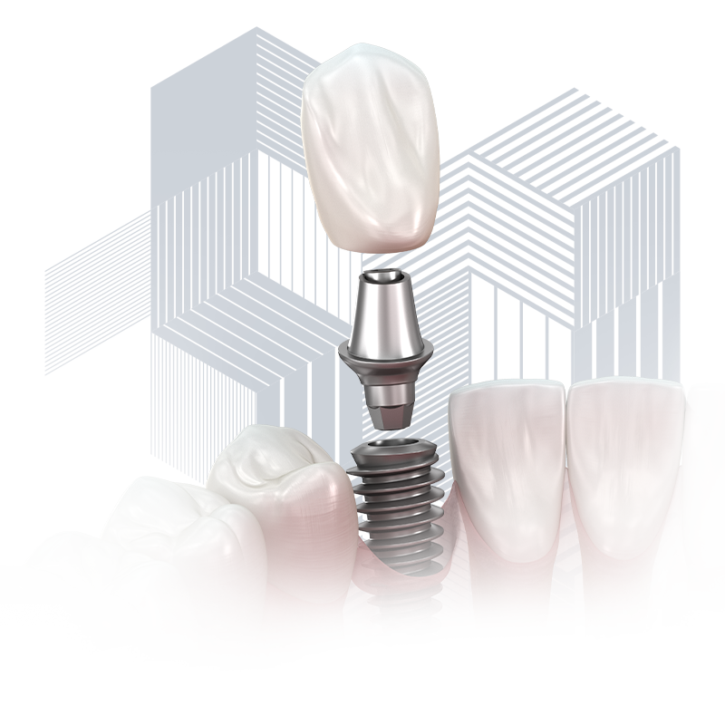 implant graphic3d1