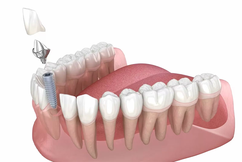 dental implant