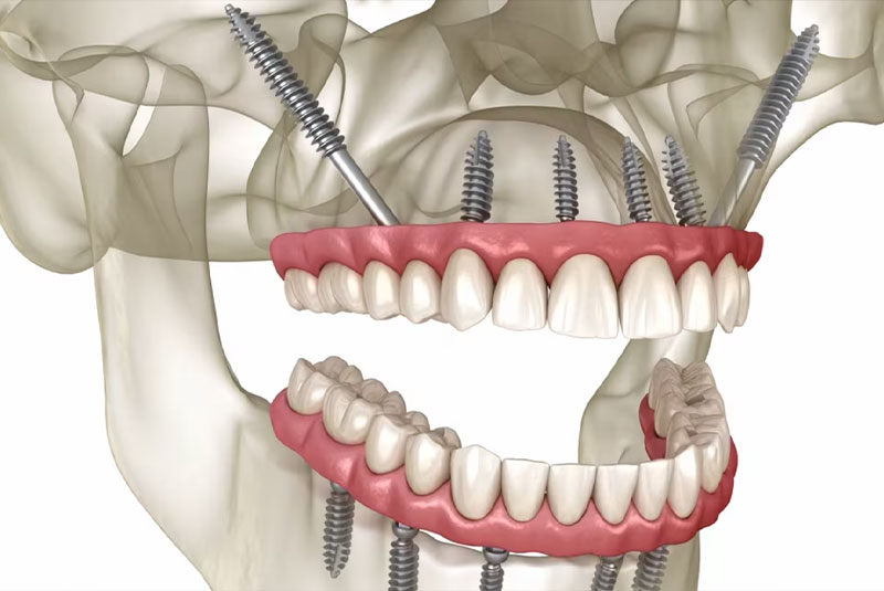Zygomatic Implants