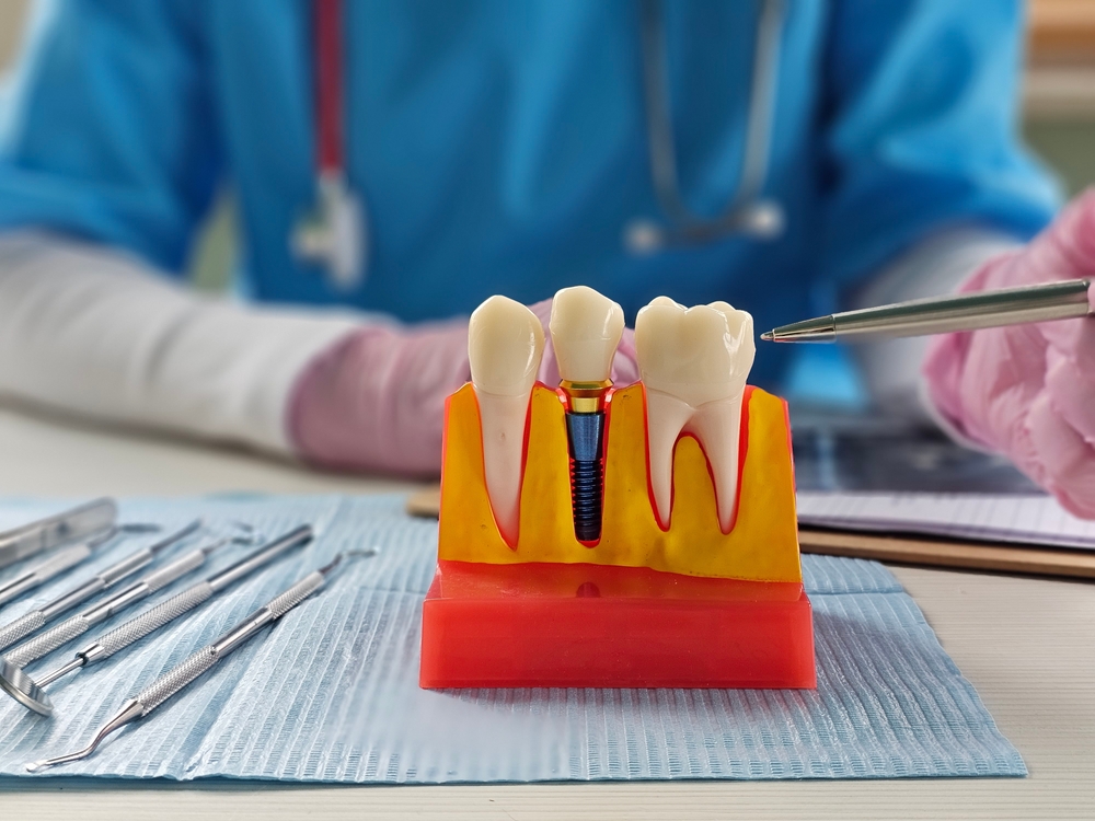 Exploring Dental Implants Options in Queen Creek, AZ